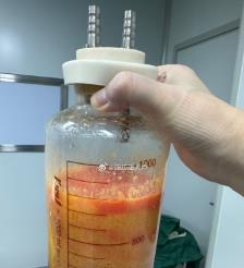 泰兴水动力吸脂手术要做多久？